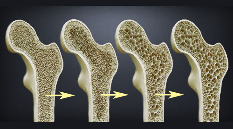 Kemik Erimesi Osteoporoz Nedir Kemik Erimesi Belirtileri Nelerdir