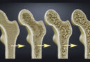 Kemik Erimesi (Osteoporoz) Nedir? Kemik Erimesi Belirtileri Nelerdir?